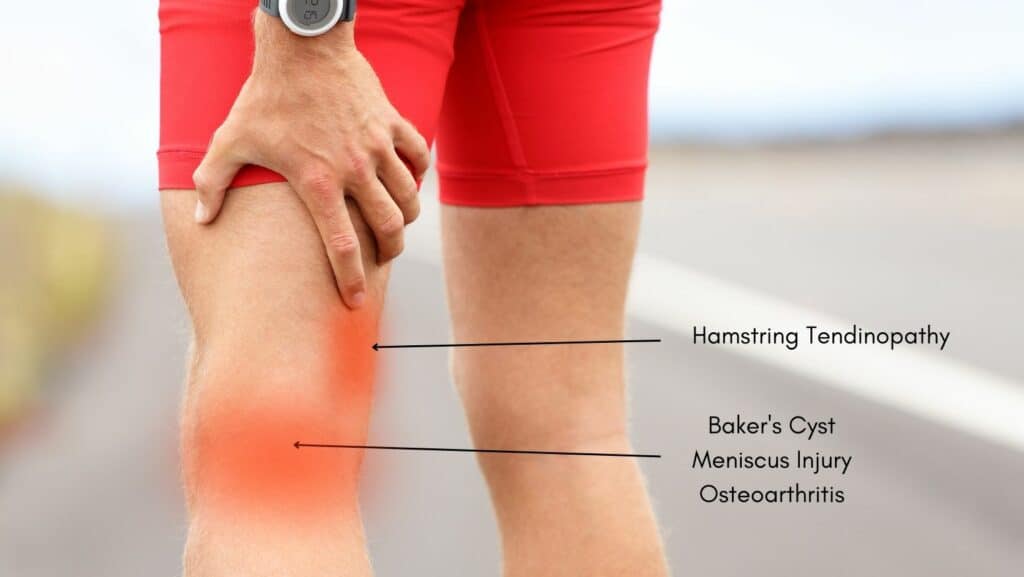 Photo of Back Of Knee Pain Running