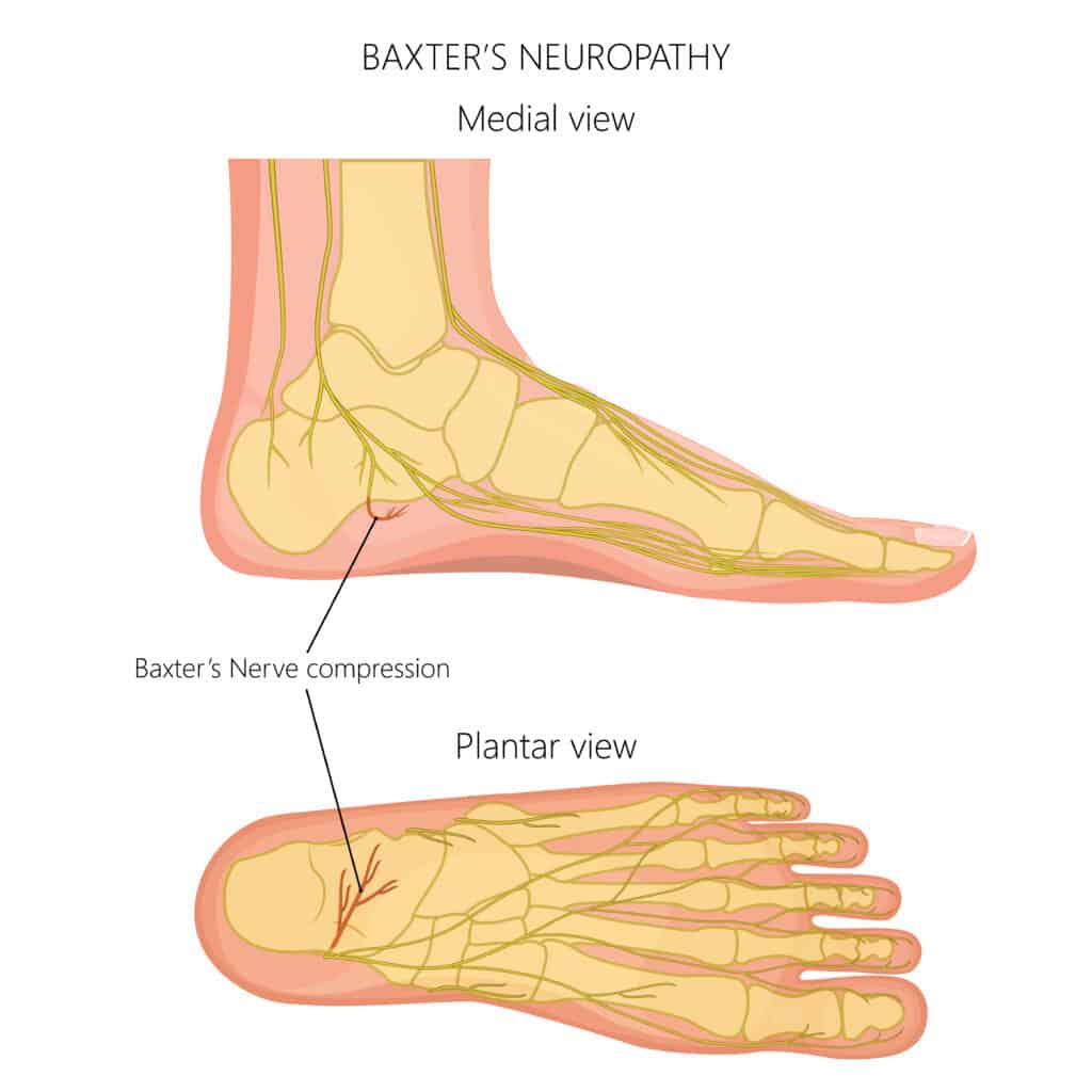 Baxter's nerve Entrapment Diagram
