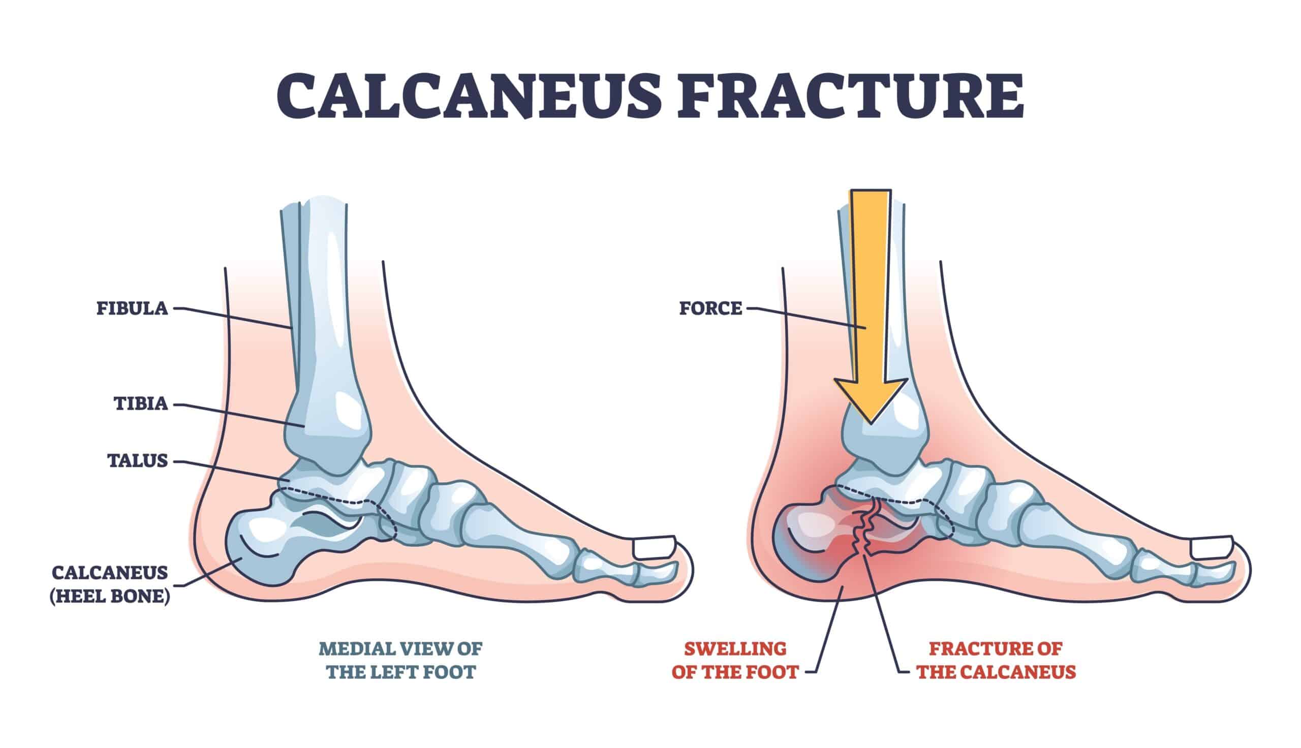 how long does it take to walk after a calcaneal fracture