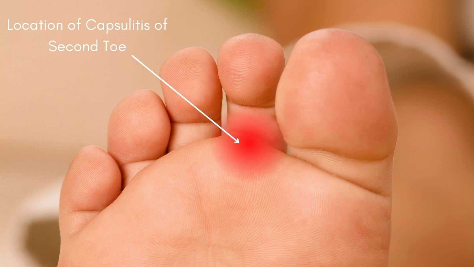 Capsulitis Of The Second Toe Symptoms Causes Treatment