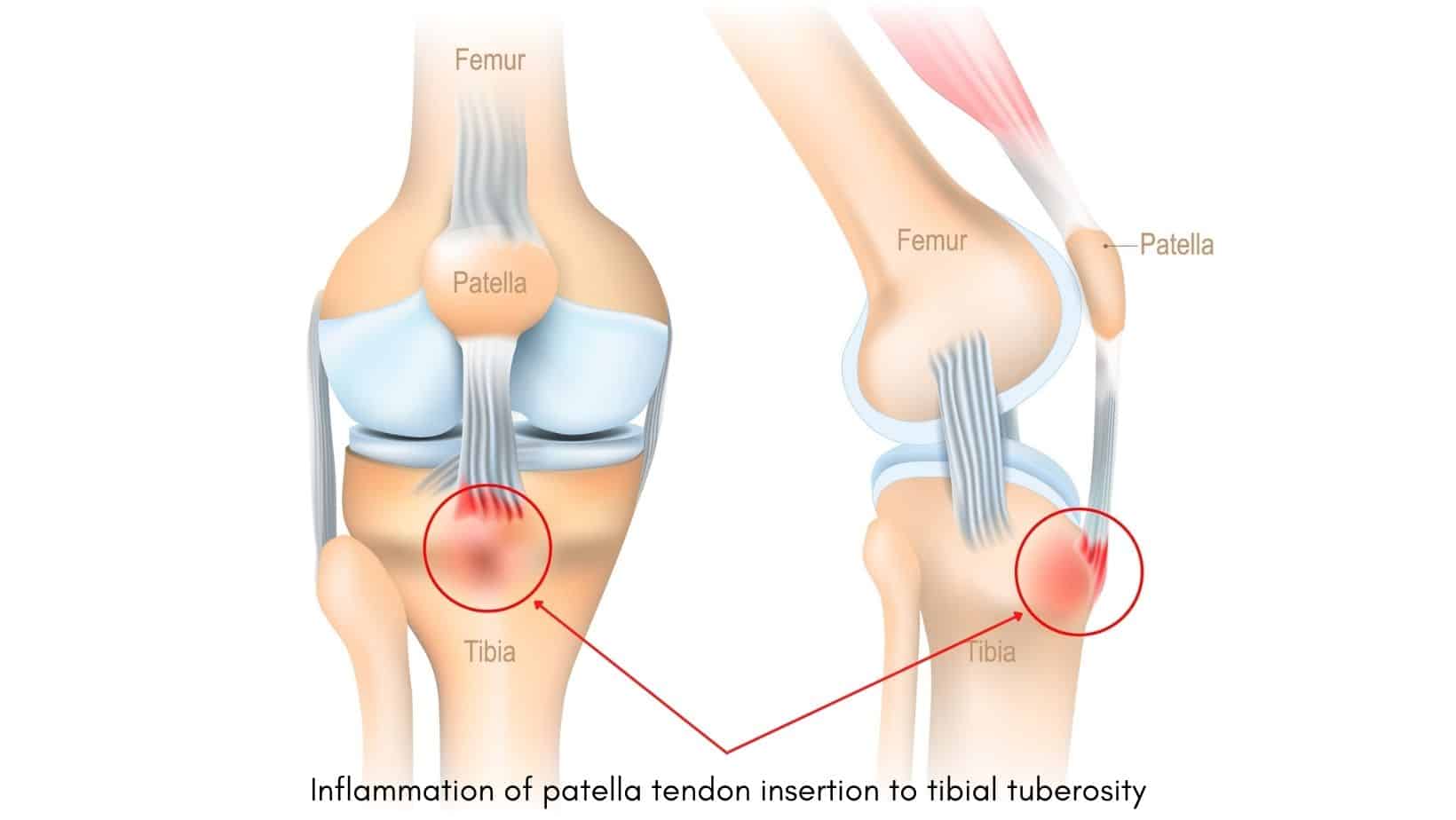 sharp-stabbing-pain-in-knee-comes-and-goes