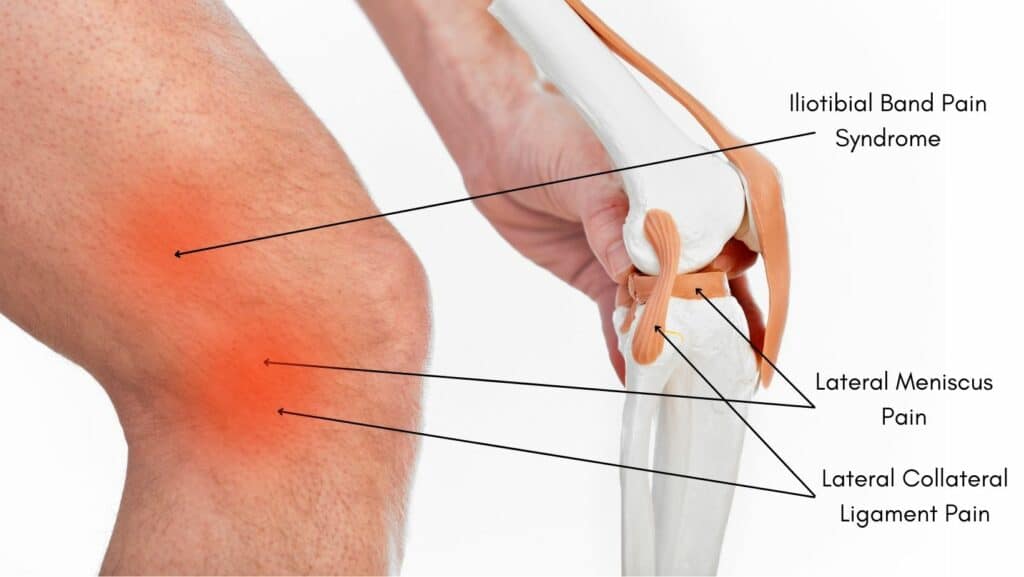 Diagram of locations of pathologies causing outside knee pain running