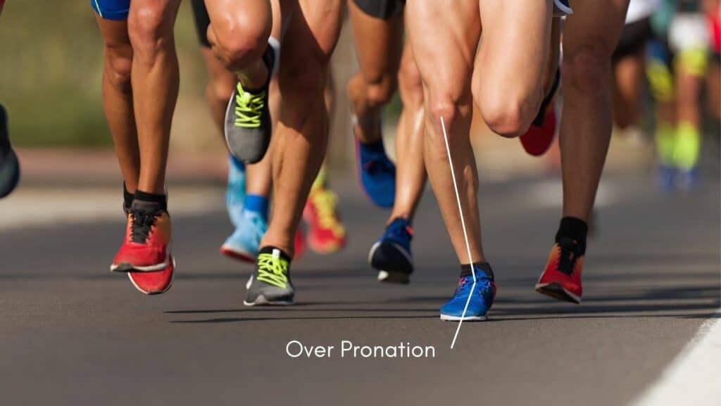 Photo of runners showing over pronation