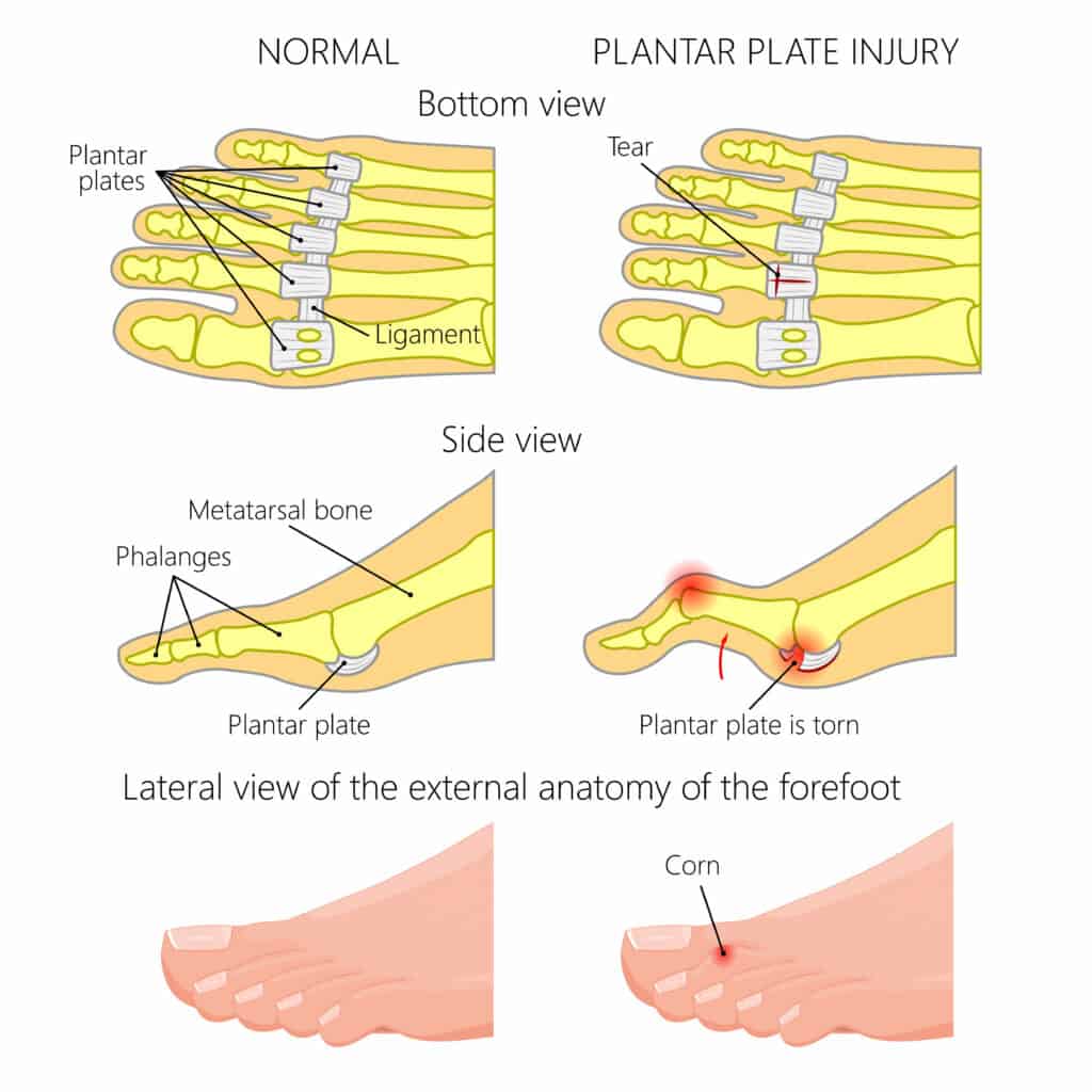 Plantar Plate Tear Diagram