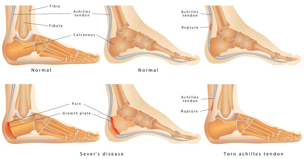 Sever's Disease Diagram