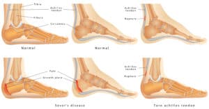 Sever‘s Disease: Explained by a Physical Therapist