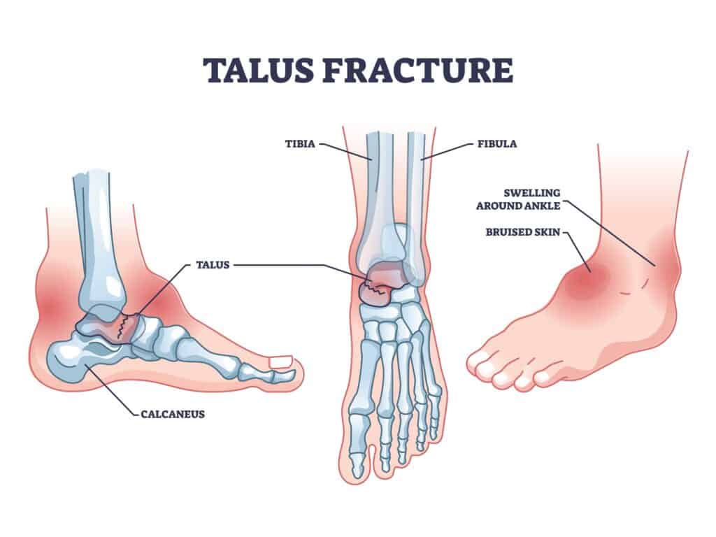 Talus Fracture Diagram