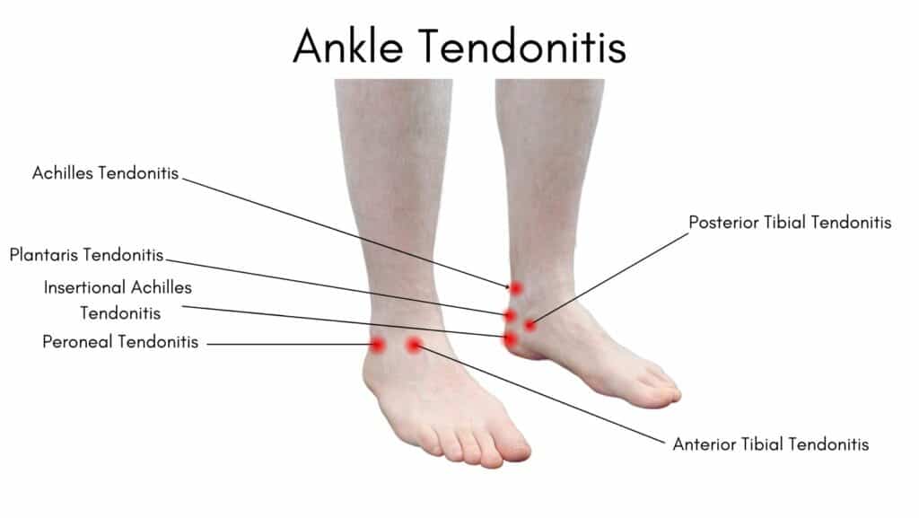 Ankle Tednonitis Diagram