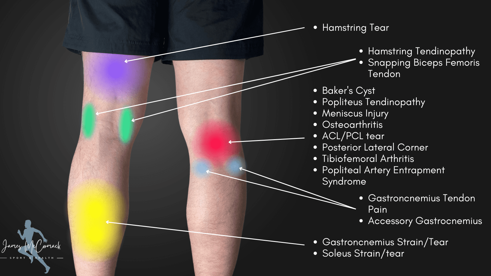 Knee Pain Location Chart Learn The Pain Location Of Knee Injuries