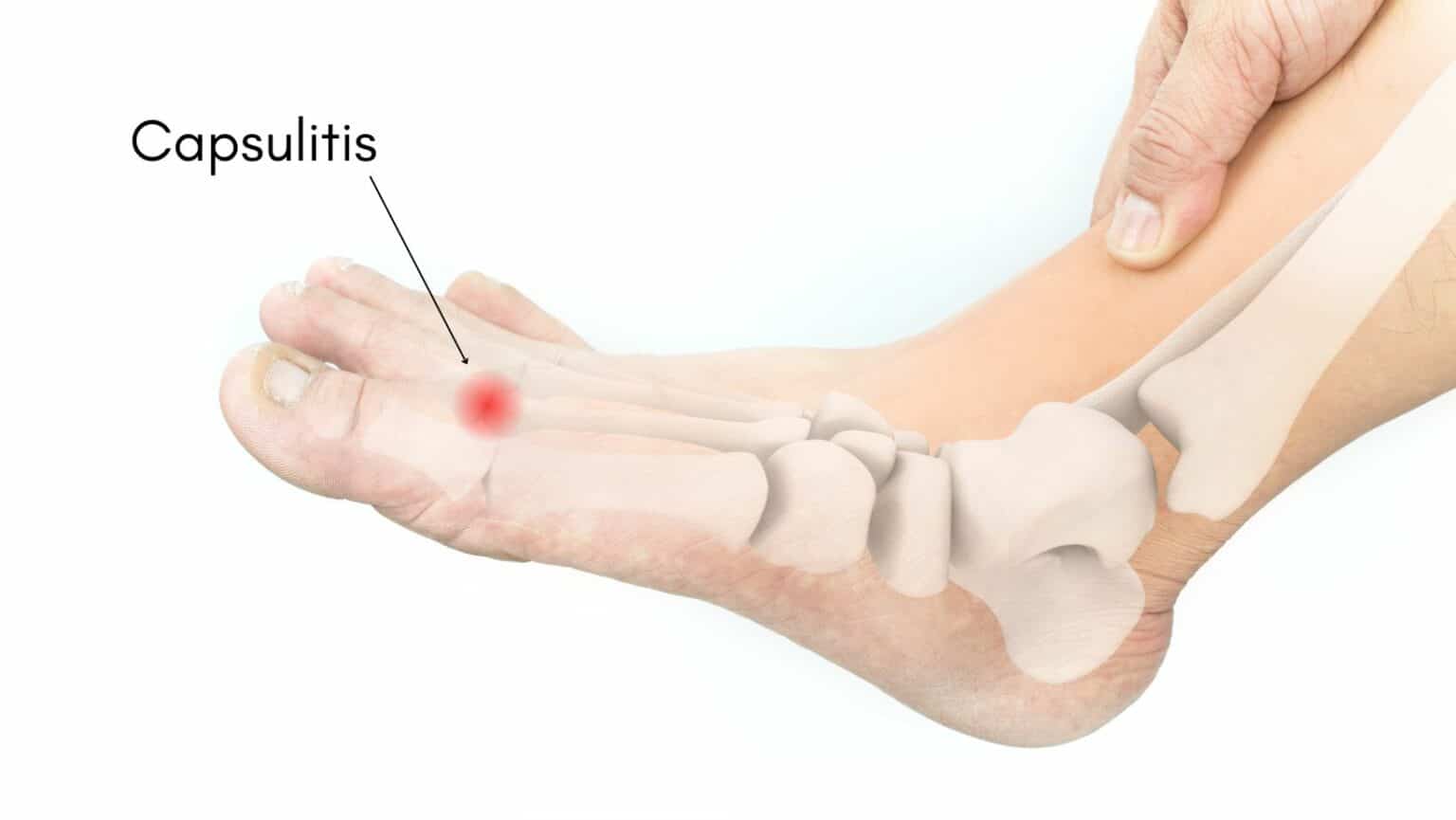 Capsulitis - Learn How to Treat Capsulitis from a Foot Specialist