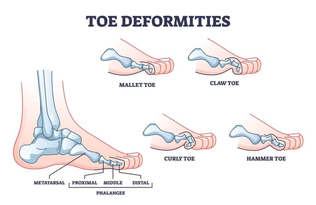 Mallet Toe vs Hammer Toe Diagram