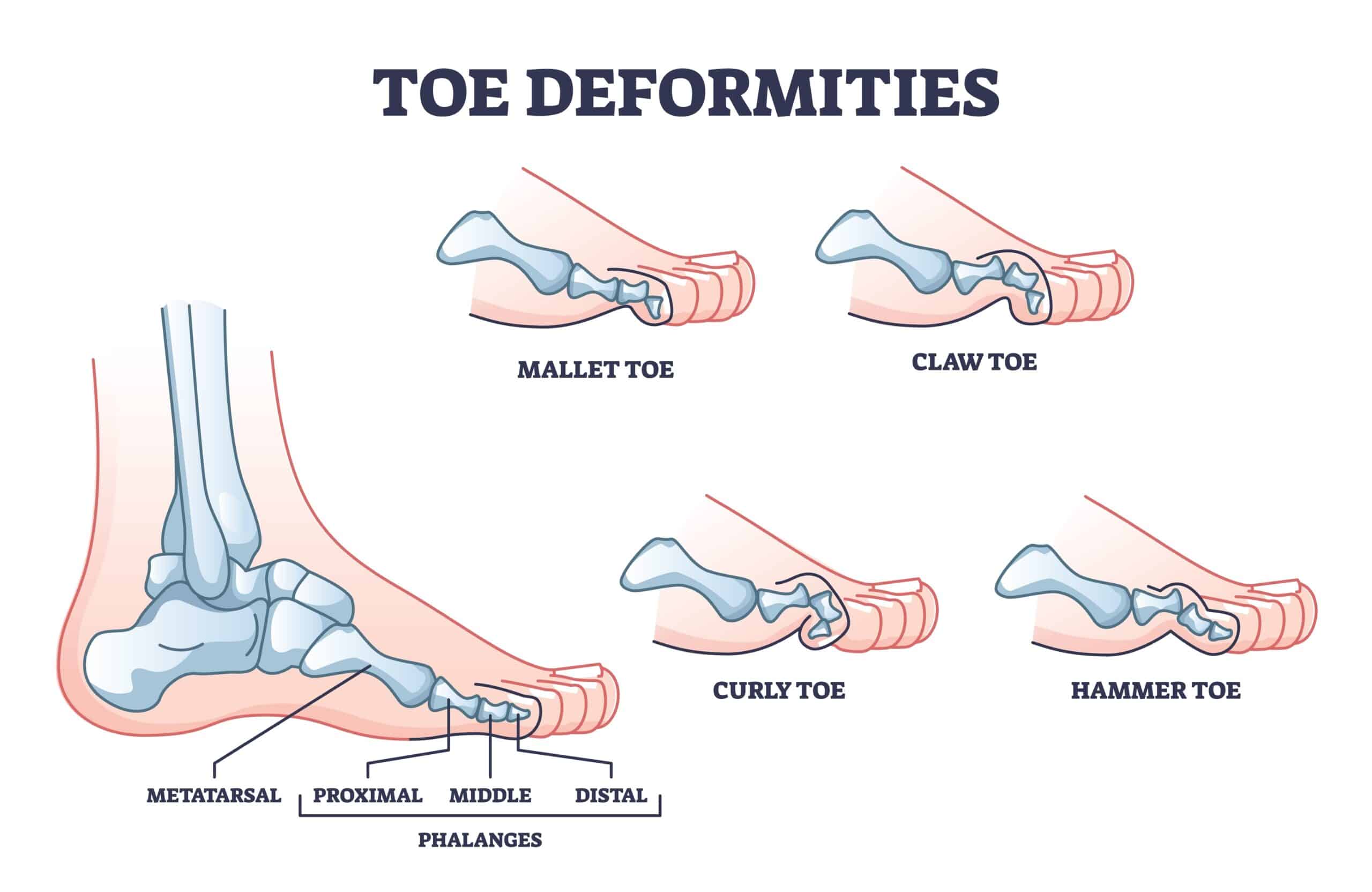 Mallet Toe Symptoms Treatment From A Foot Specialist