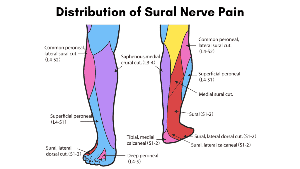 Diagram of the Distribution of Sural Nerve Pain