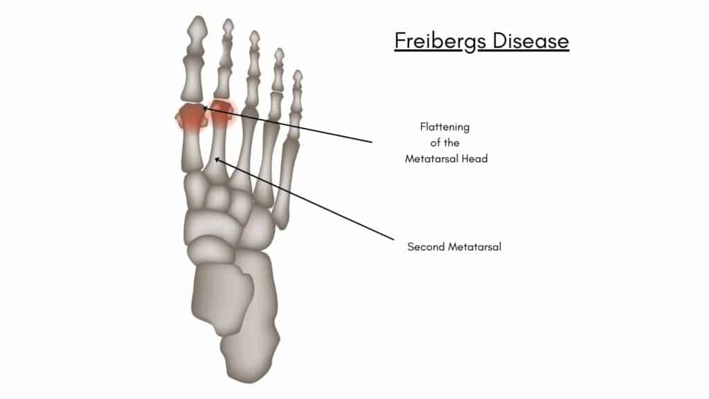 Freibergs Disease Diagram