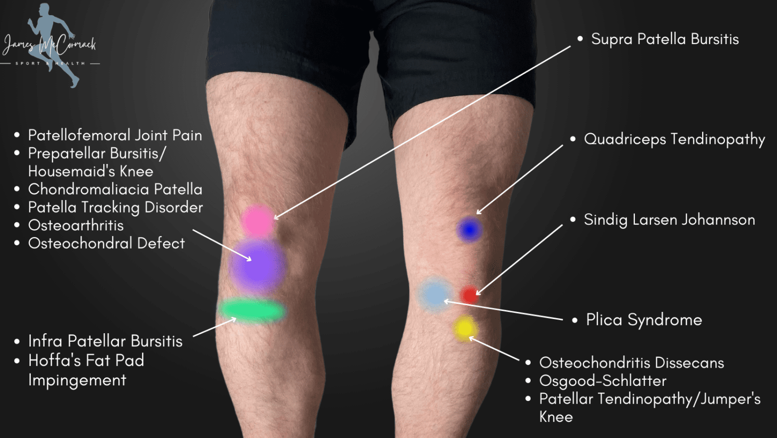 Knee Pain Location Chart | Learn the Pain Location of Knee Injuries