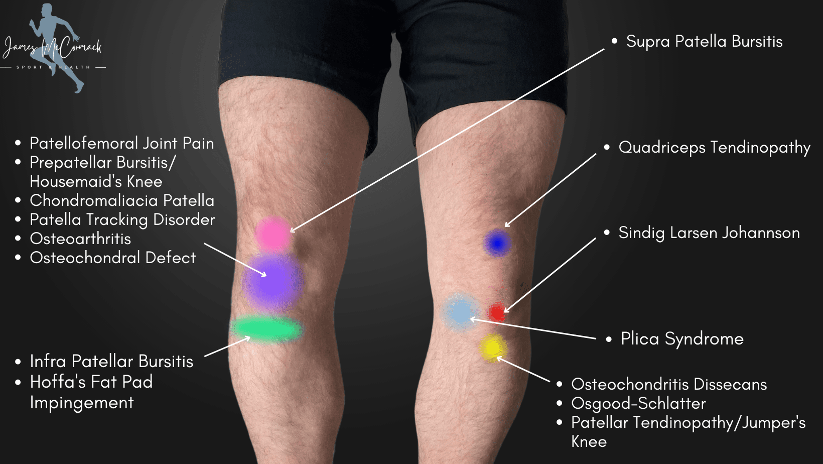 Knee Pain Locations Chart