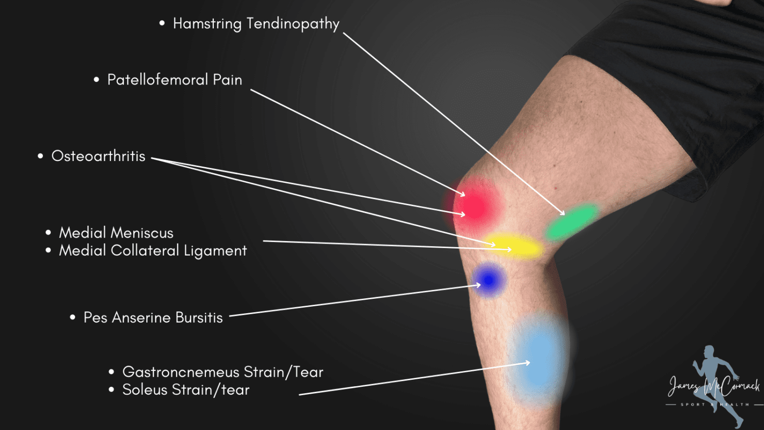 Knee Pain Location Chart Learn the Pain Location of Knee Injuries