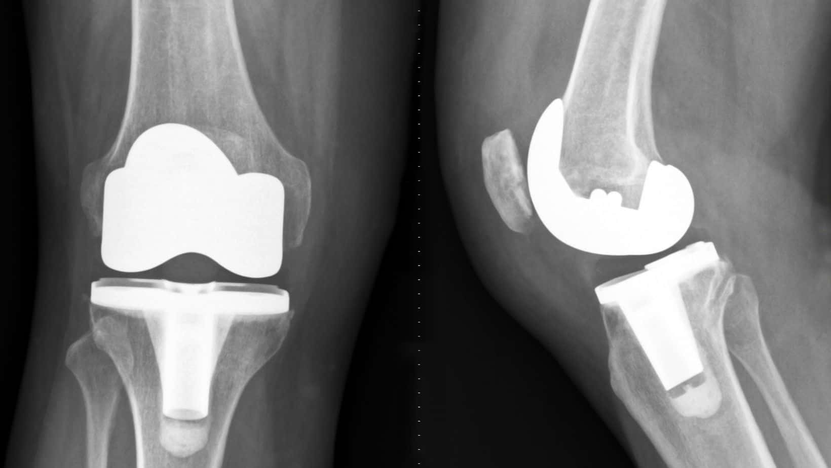 top-5-mistakes-after-knee-replacement-by-a-knee-specialist