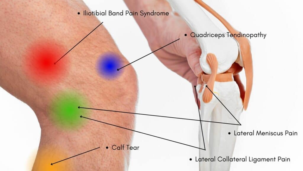 photo of lateral knee pain location chart