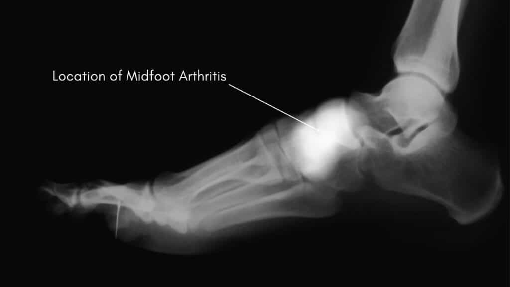 Location of midfoot arthritis