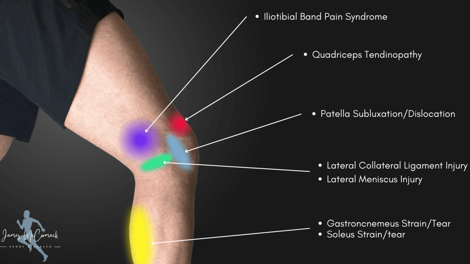 Knee Pain Location Chart Learn The Pain Location Of Knee Injuries Knee Pain Location Chart Learn The Pain Location Of Knee Injuries