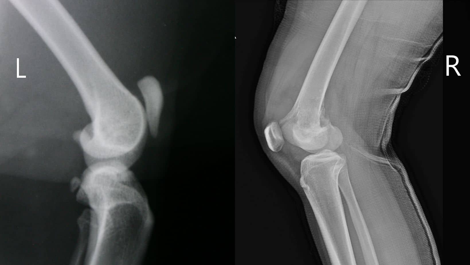 Patella Alta | Pain and Instability of the Knee Cap