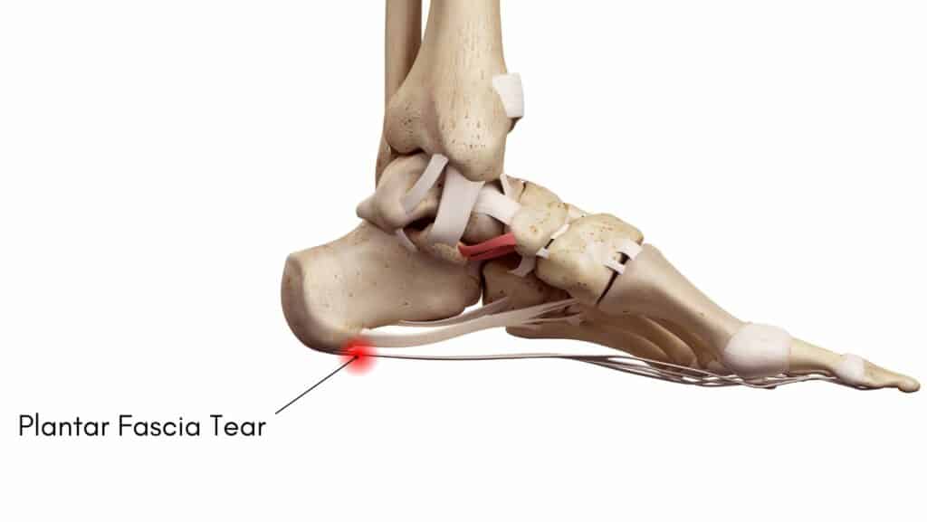 Picutre diagram of Plantar Fascia Tear