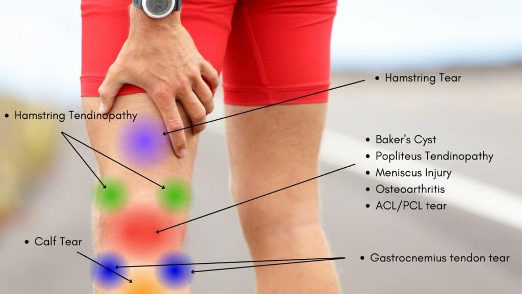 photo of posterior knee pain location chart