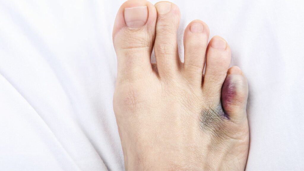 Picture of Sprained Pinky Toe