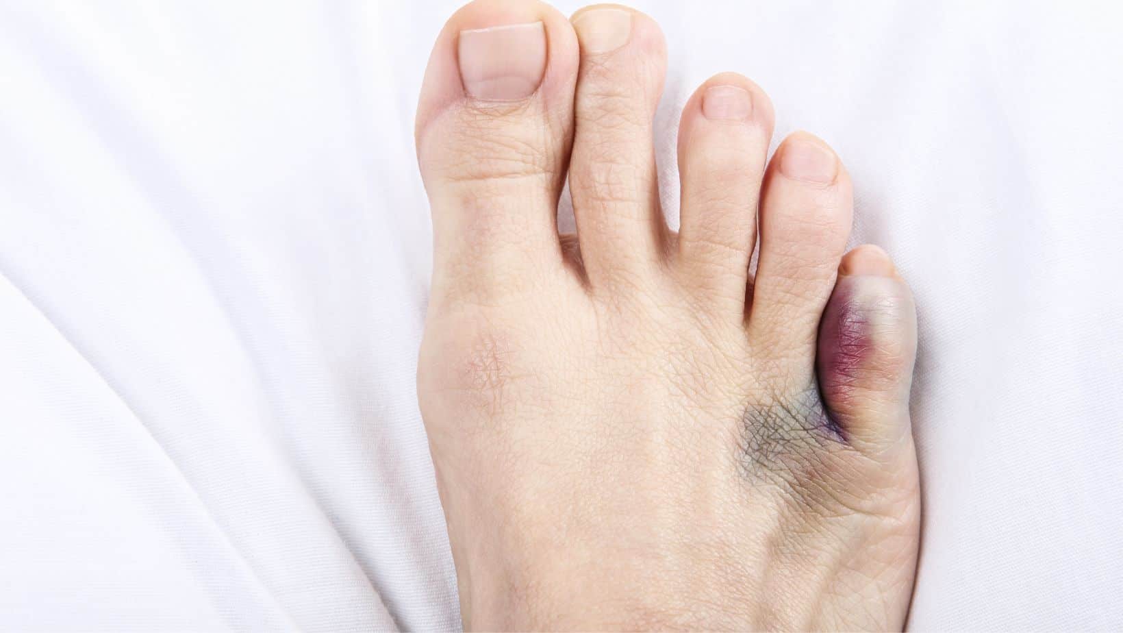 Pinky Toe Pain 4 Common Conditions That Cause Pinky Toe Pain   Sprained Pinky Toe 