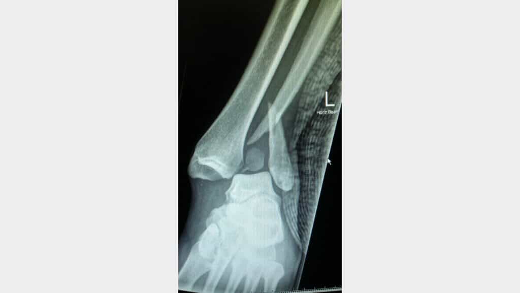 X-ray of Ankle Dislocation and Fibula Fracture