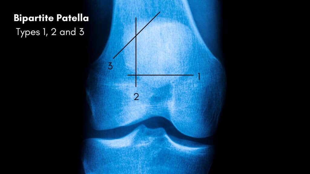 Diagram of bipartite patella