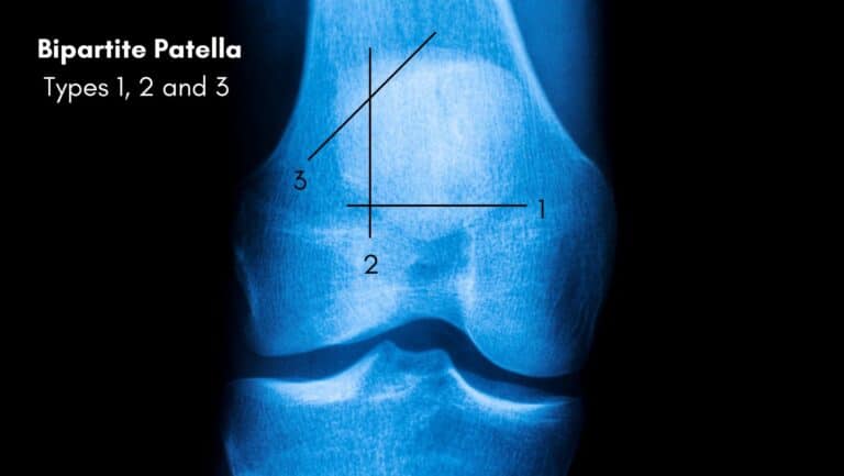 Bipartite Patella Rare Congenital Bipartite Patella