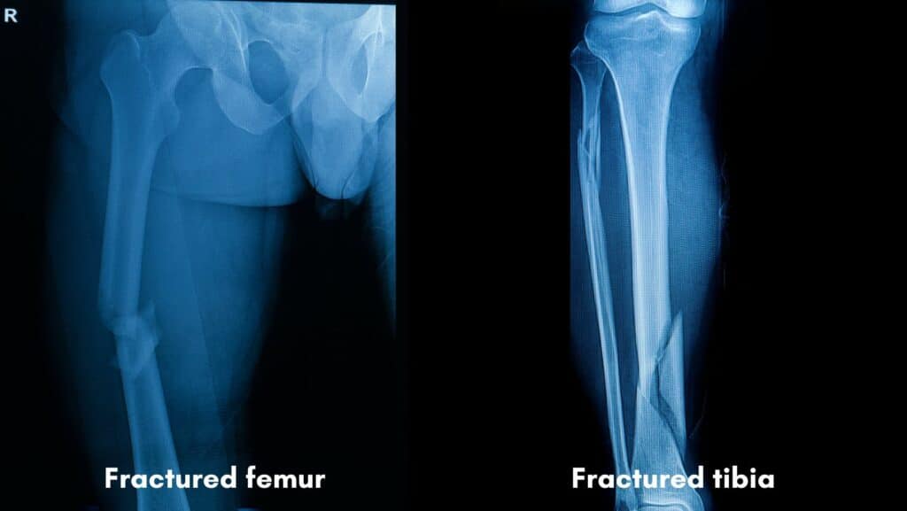 Xray of femur and tibia fracture
