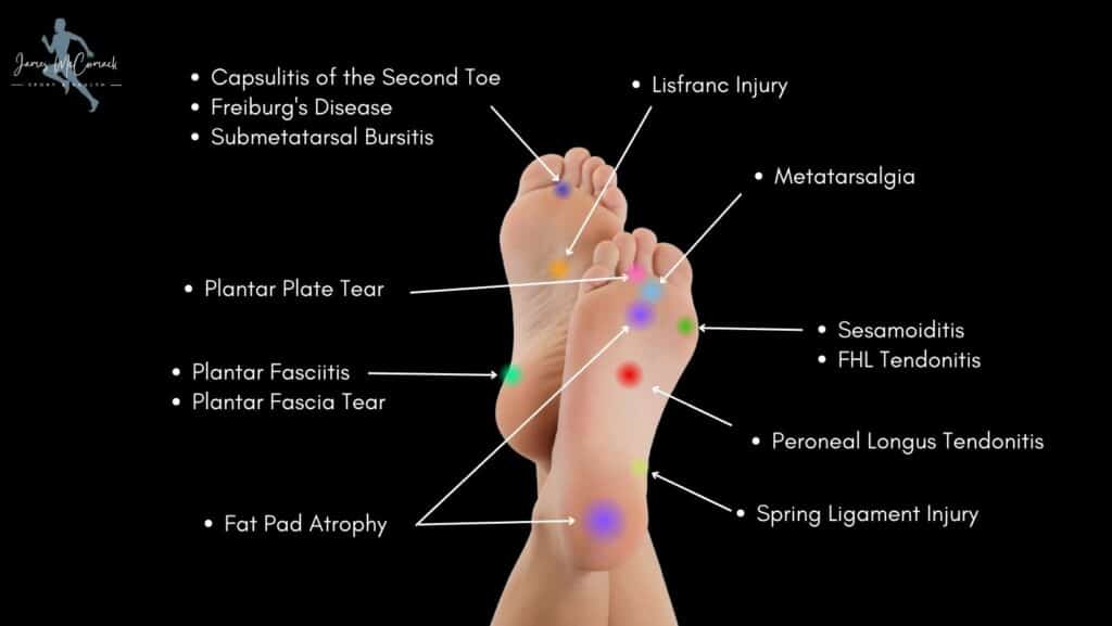 Foot Pain Chart Top of Foot, Side and Front of Foot Pain Chart