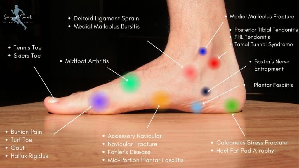 Foot Pain Chart - Inner Foot Pain Diagram