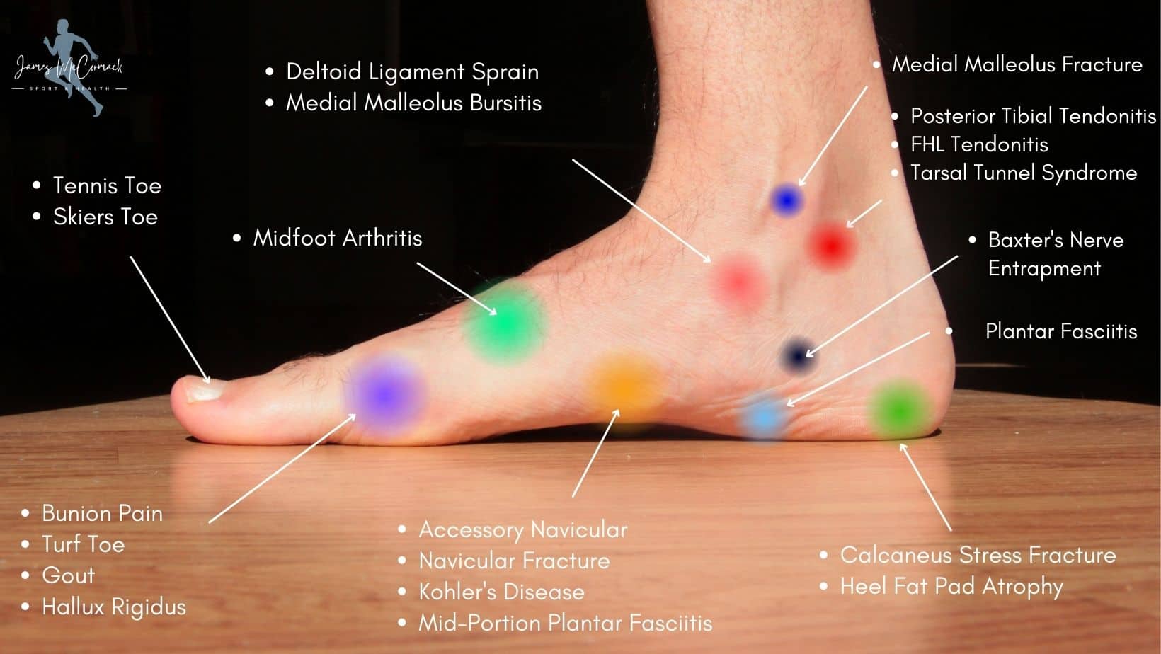 Foot Pain Chart: Top of Foot, Side and Front of Foot Pain Chart