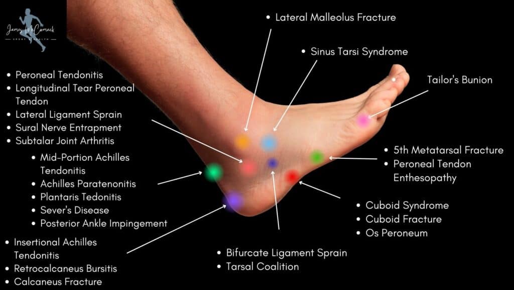 Foot Pain Chart - Outer Foot Pain