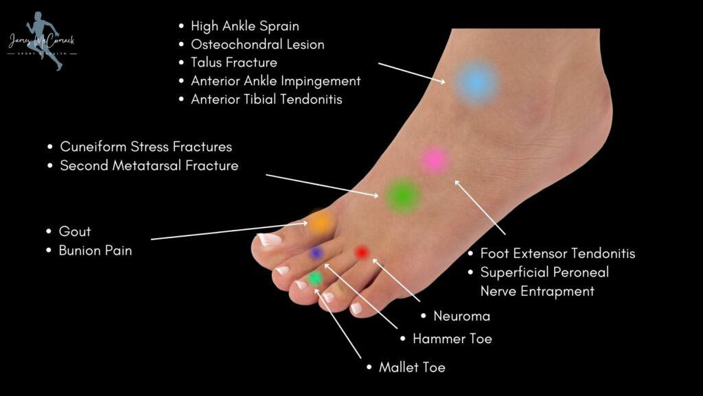 Foot Pain Chart - Top of Foot Pain Diagram