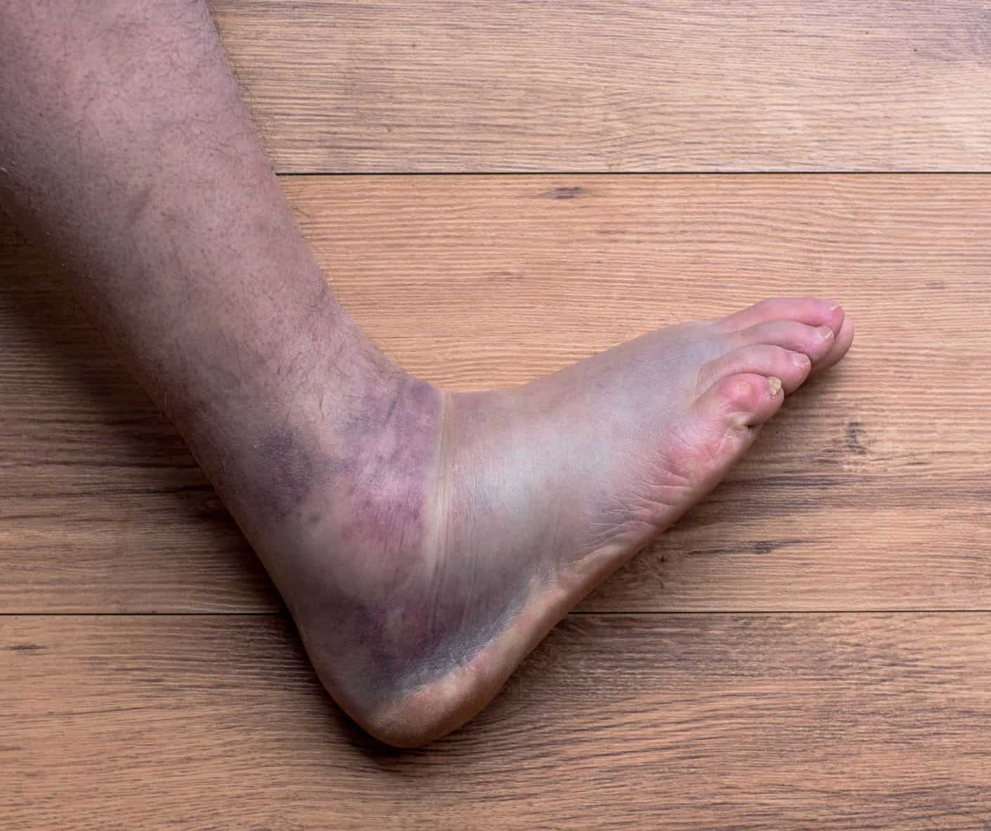 What Can Cause Your Left Ankle To Swell