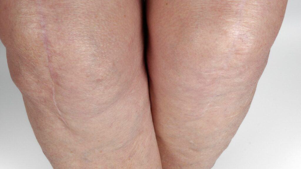 Photo of Knee Replacement Scar 1 year