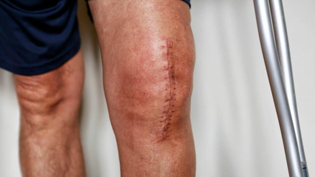 Photo of Knee Replacement Scar 3 weeks