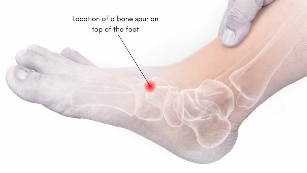 Diagram showing the Location of bone spur on top of foot