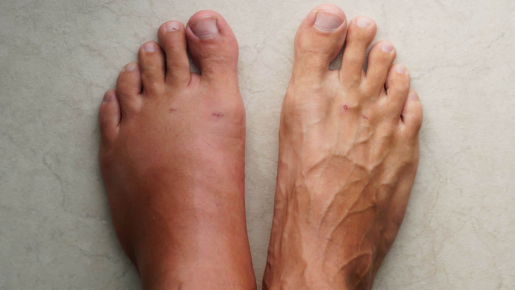 understanding-varicose-veins-in-the-feet-vein-institute-of-pinellas