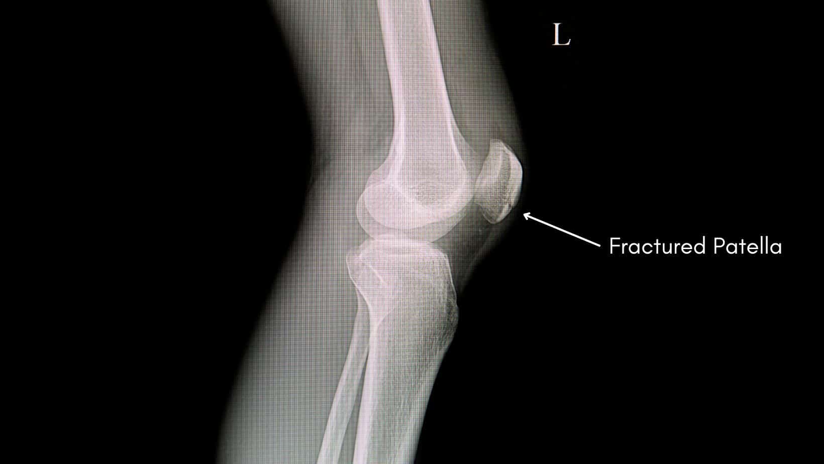 Patella Fracture