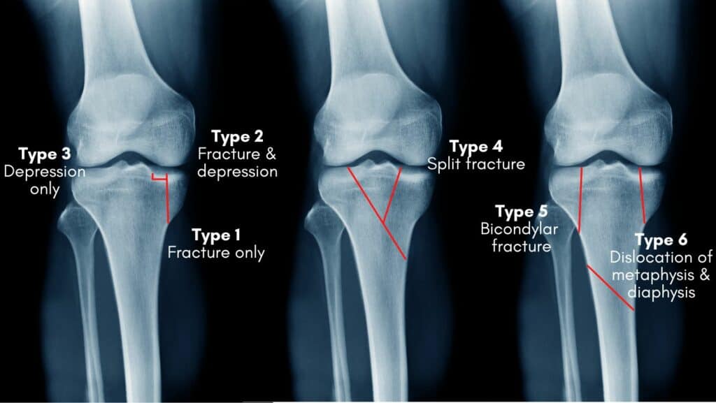 Tibial Plateau Fracture Classification And Treatment 2722