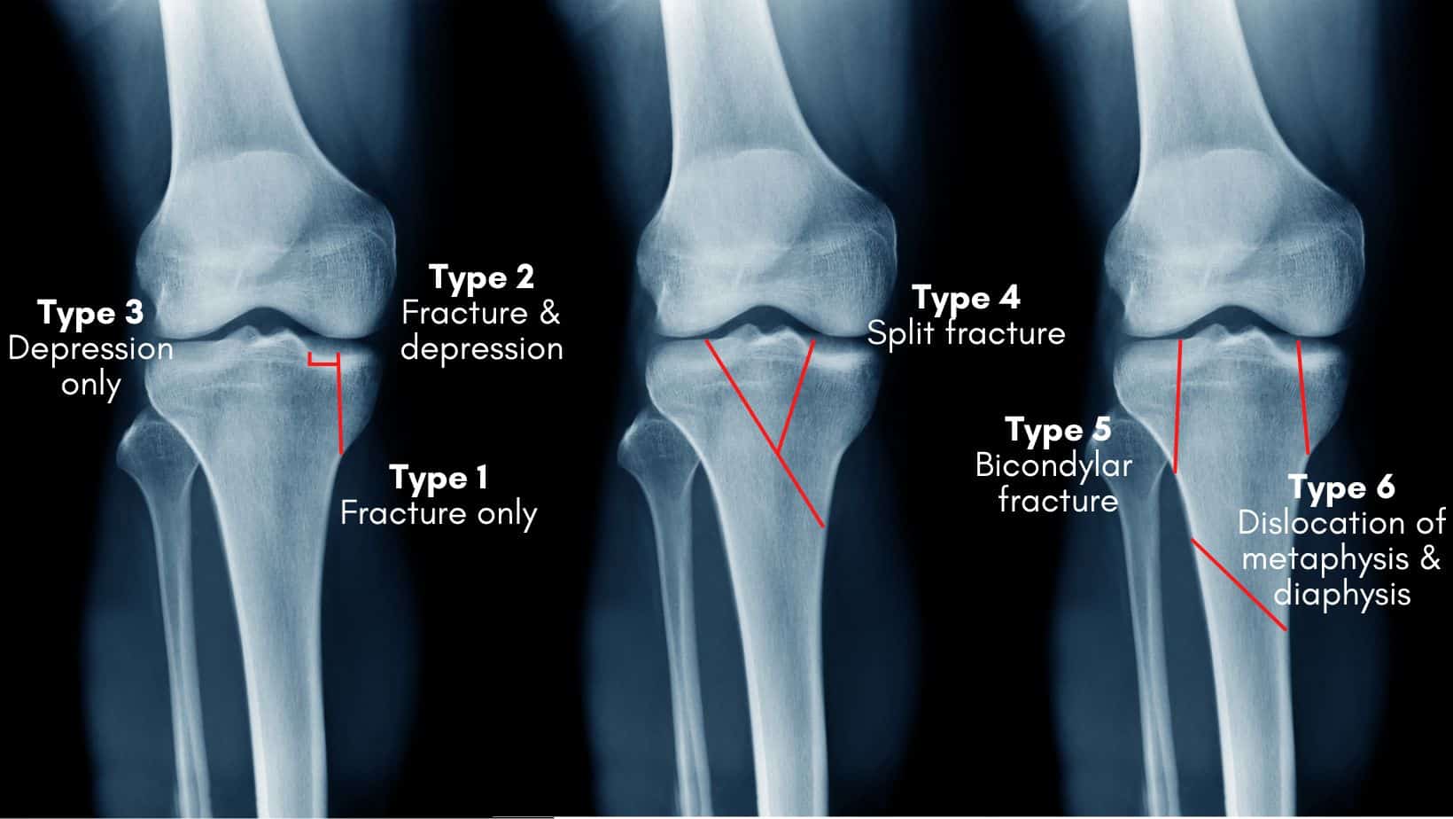Tibial Plateau Fracture