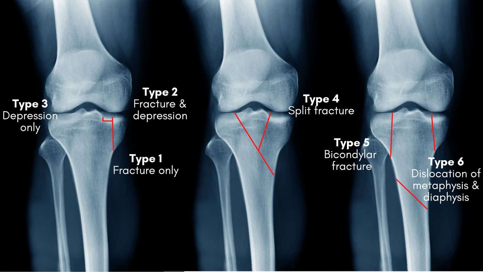 Tibial Plateau Fracture Classification And Treatment 4244