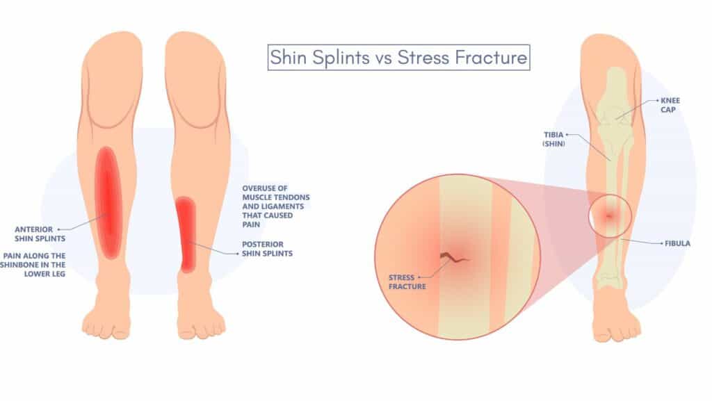 Picture of Shin Splints vs Stress Fracture