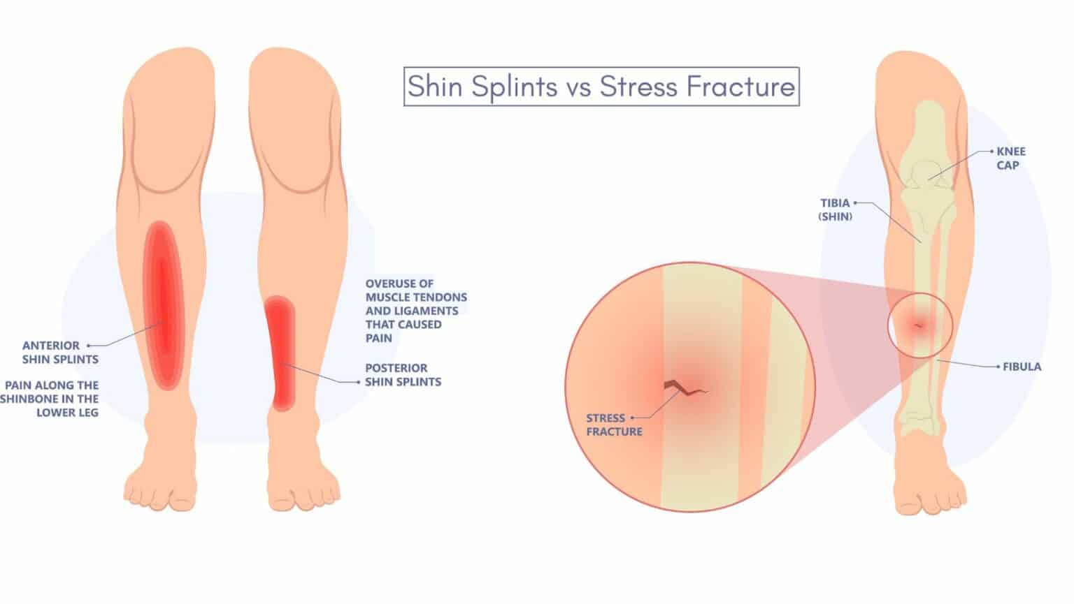 Shin Splints vs Stress Fracture Differences by a Foot Specialist